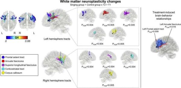 神经可塑性研究显示唱歌如何恢复中风后失语症的语言生产