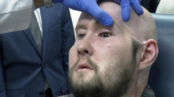 外科医生完成了全球首例眼部移植手术